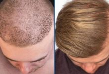 Hair Transplant Turkey: Advanced Techniques for Optimal Results