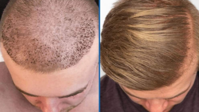 Hair Transplant Turkey: Advanced Techniques for Optimal Results