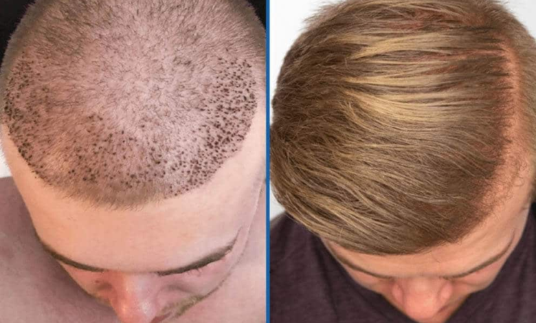 Hair Transplant Turkey: Advanced Techniques for Optimal Results